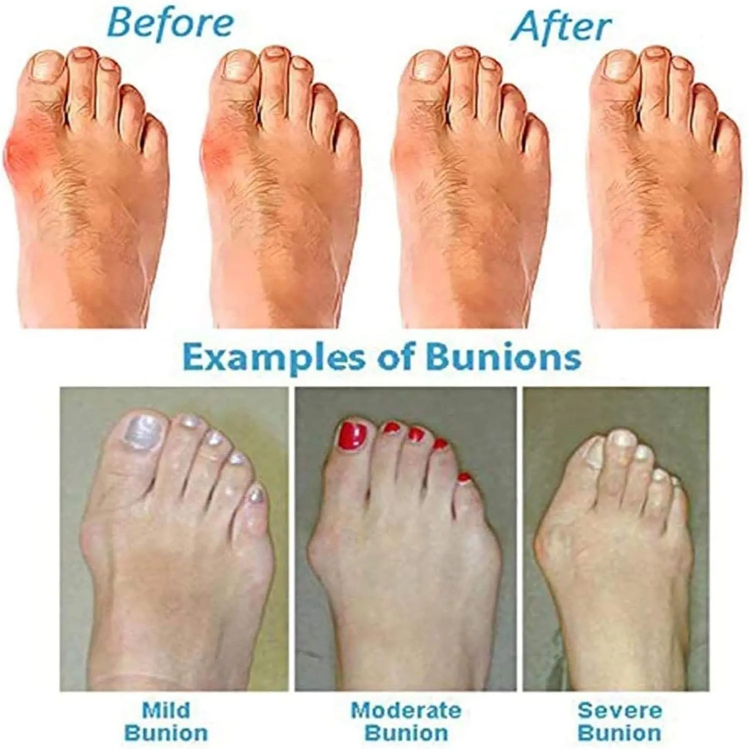 Summer Women's Slip-on Sandals, Comfort Flat Roman Snake Print Cross Buckle Strap Orthopedic Bunion Corrector Sandals, for Big Toe Bone Orthopedic Beach Shoes